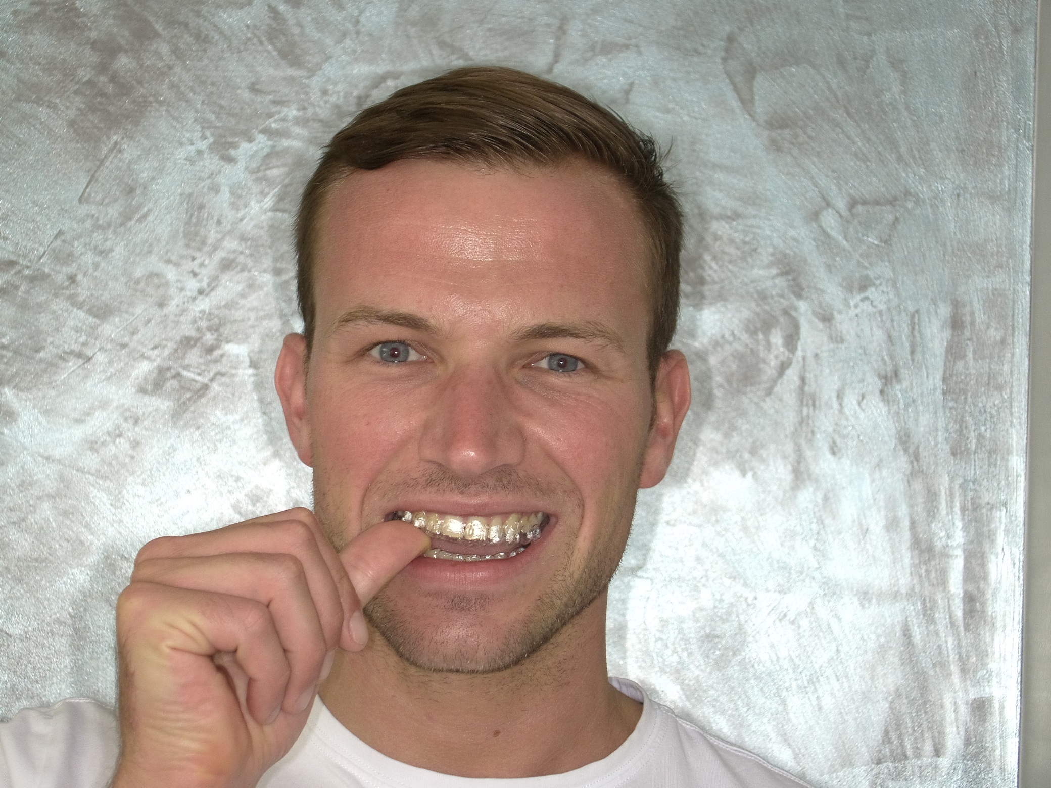 gouttière Invisalign