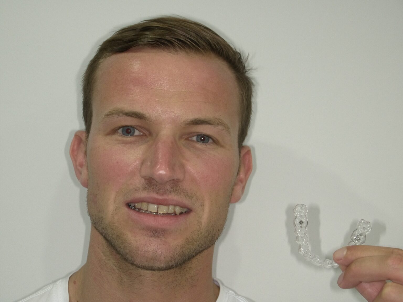 gouttière Invisalign